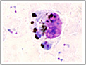 Goccia spessa. Plasmodium falciparum: macrofago con pigmento fagocitato; quattro trofozoiti