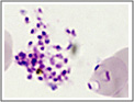 Striscio sottile. Plasmodium falciparum: uno schizonte rotto ed un'emazia parassitata da tre trofozoiti