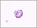 Goccia spessa. Plasmodium malariae: gametocita
