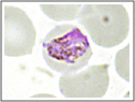 Striscio sottile. Plasmodium malariae: emazia parassitata da un trofozoite