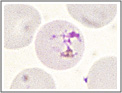 Striscio sottile. Plasmodium malariae: emazia parassitata da un giovane trofozoite