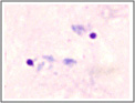 Goccia spessa. Plasmodium vivax: due trofozoiti
