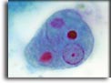 Entamoeba histolytica, trofozoite. Per saperne di più: Division of Parasitic Diseases (DPDx)-CDC.