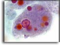 Trofozoite di Entamoeba histolytica. Per saperne di più: Division of Parasitic Diseases (DPDx)-CDC.