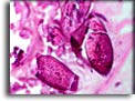 E&E. Uova di Schistosoma haematobium in parete vescicale. Per saperne di più: Division of Parasitic Diseases (DPDx)-CDC.