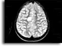Cisticerco in tessuto cerebrale. Per saperne di più: Division of Parasitic Diseases (DPDx)-CDC.