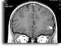 Cisticerco in tessuto cerebrale. Per saperne di più: Division of Parasitic Diseases (DPDx)-CDC.
