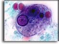 Trofozoite di Entamoeba histolytica con eritrociti fagocitati. Per saperne di più: Division of Parasitic Diseases (DPDx)-CDC.